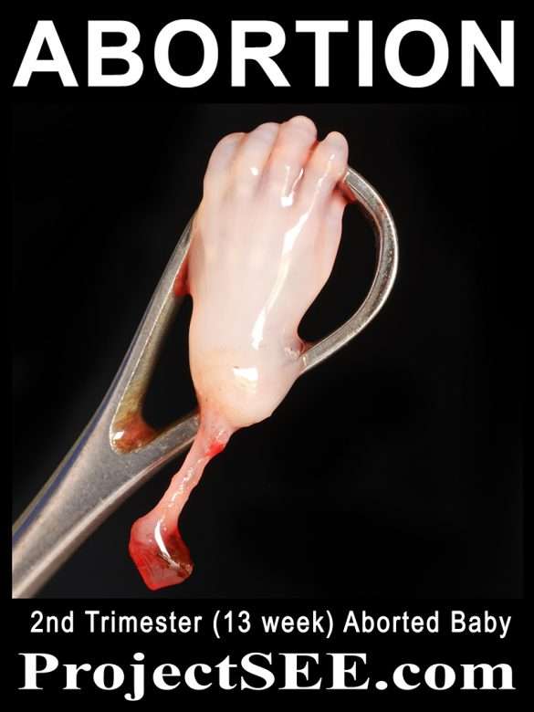 13 WEEK ABORTED BABY