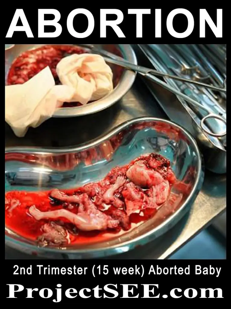 15 WEEK ABORTED BABY